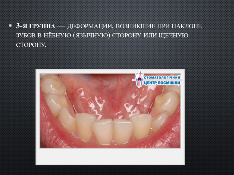 3-я группа — деформации, возникшие при на­клоне зубов в нёбную (язычную) сторону или щечную